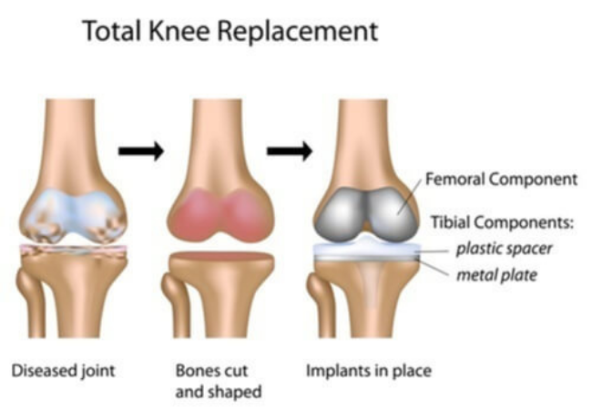 Knee replacement illustration