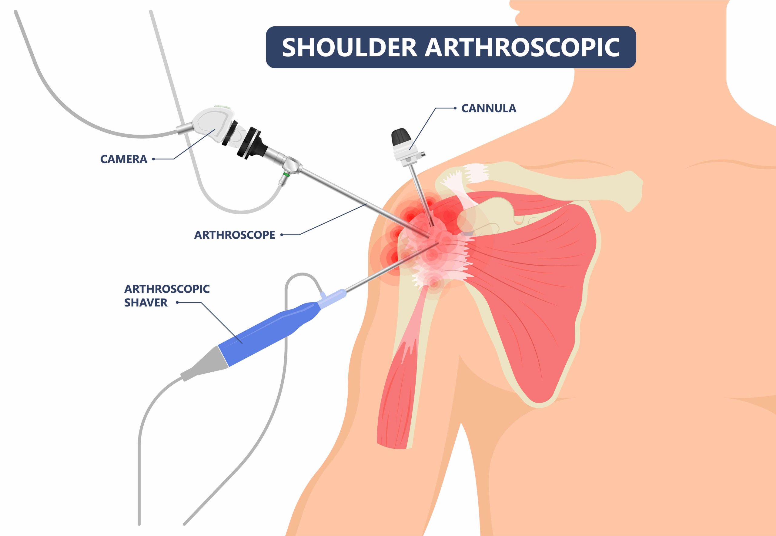 Shoulder arthroscopy illustration