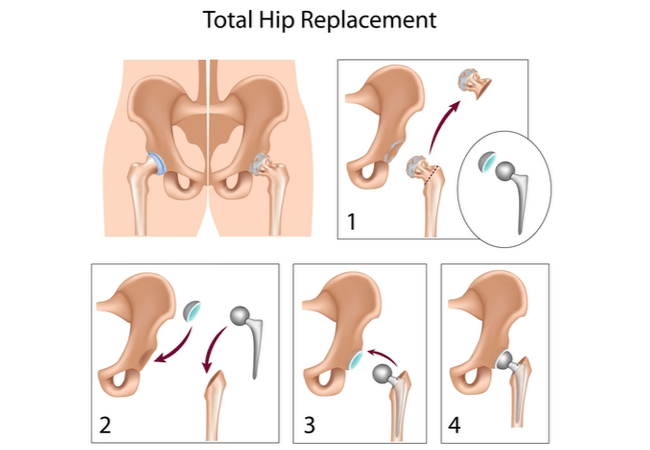 HIP JOINT REPLACEMENT ILLUSTRATION