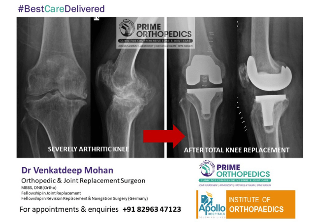 Before after pics of Total Knee Replacement