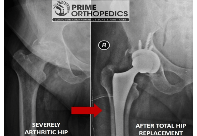 Before & after pictures of hip joint replacement