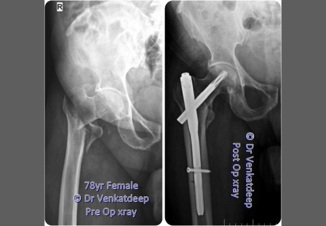 78 Yr Female Hip Fracture Prime Ortho