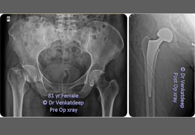 81 Yr Old Female Hip Fracture Prime Ortho