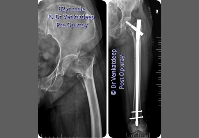 82 Yr Male Hip Fracture Prime Ortho