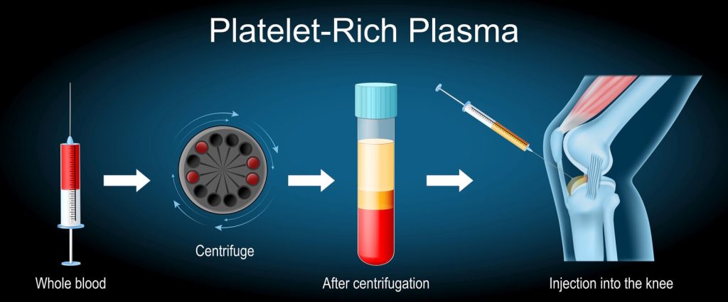 Platelet Rich Plasma Preparation For Knee Arthritis Dr Venkatdeep Orthopaedic Surgeon Bangalore