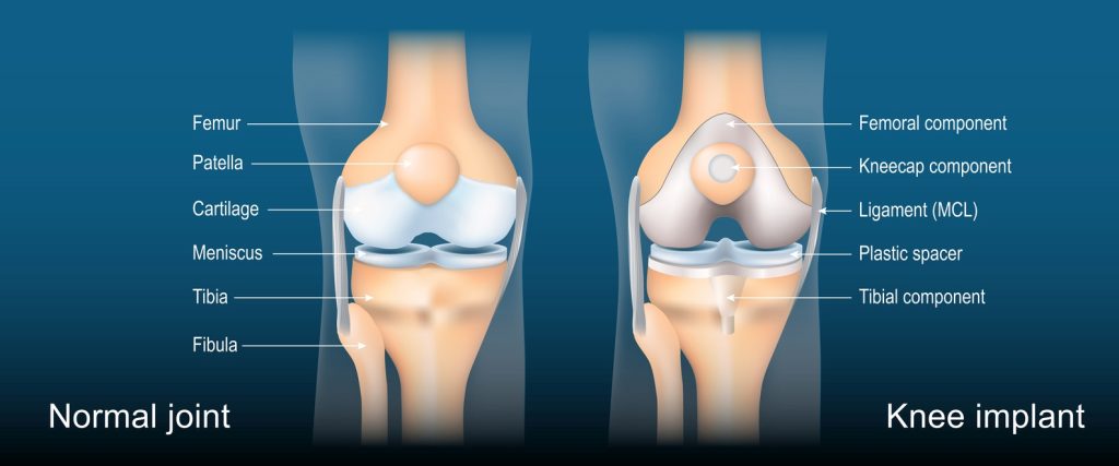 Total Knee Arthroplasty. Knee Joint Replacement